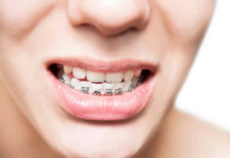 Niềng răng có thể khắc phục được tình trạng móm hay không?
