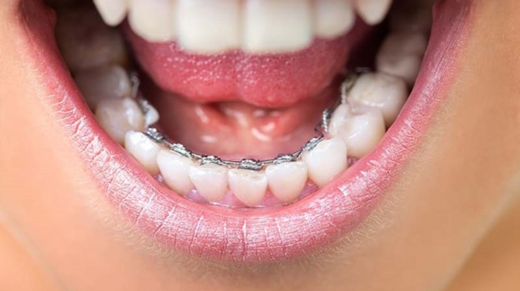 Niềng răng mắc cài kim loại mặt trong là gì?